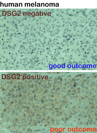 Human melanoma showing DSG2 negative and DSG2 positive 